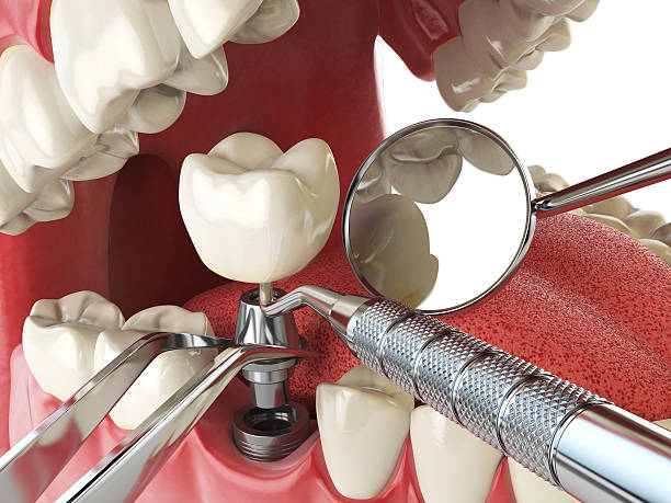 Best Emergency Wisdom Tooth Extraction in Nazareth, PA